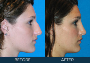 Rhinoplasty Case 5289