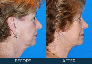 Rhinoplasty Case 6932