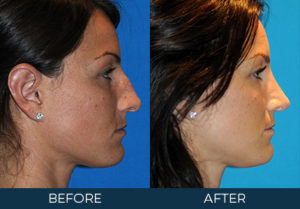 Rhinoplasty Case 7243