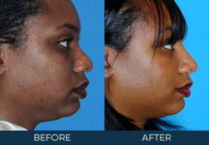 Rhinoplasty Case 7349