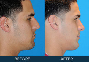 Rhinoplasty Case 7484