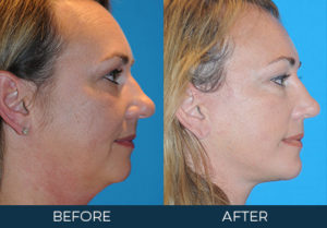 Rhinoplasty Case 7658