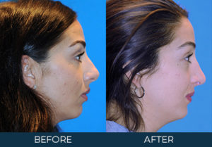 Rhinoplasty Case 8725