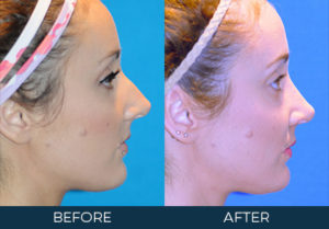 Rhinoplasty Case 8838