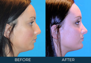 Rhinoplasty Case 8862