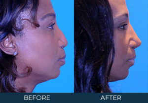 Rhinoplasty Case 9145