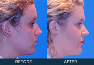 Rhinoplasty Case 9397