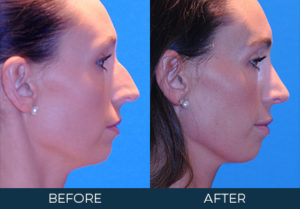 Rhinoplasty Case 9676