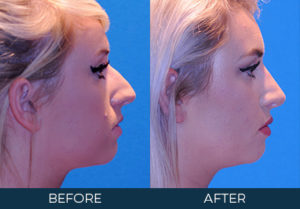 Rhinoplasty Case 9696