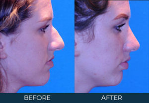 Rhinoplasty Case 10080