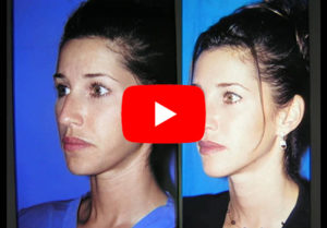 Rhinoplasty Gallery Video 1