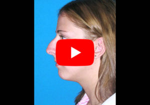 Rhinoplasty Gallery Video 2