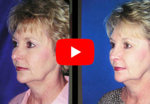 Rhinoplasty Gallery Video 4