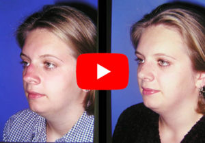 Rhinoplasty Gallery Video 5