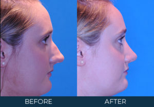 Rhinoplasty Case 10436