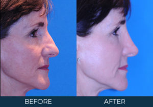 Rhinoplasty Case 10360