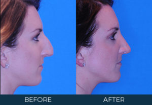 Rhinoplasty Case 9950