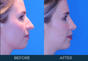 Rhinoplasty Case 9678