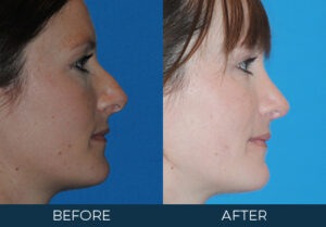 Rhinoplasty Case 5085