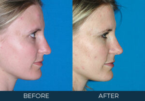 Rhinoplasty Case 5111