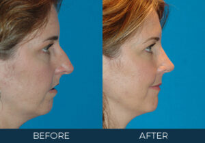 Rhinoplasty Case 5677