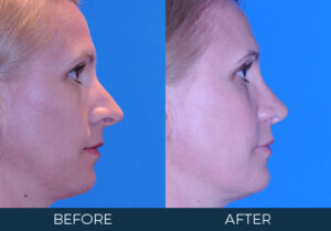 Rhinoplasty Case 10391