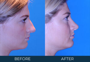 Rhinoplasty Case 10951