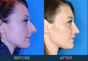 Rhinoplasty Case 11604