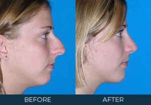 Rhinoplasty Case 3262