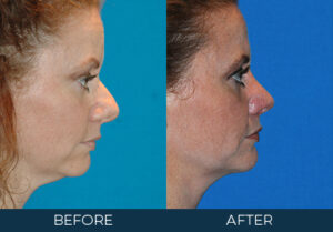 Rhinoplasty Case 6729