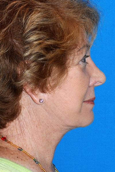 Revision Facelift, Rhinoplasty After